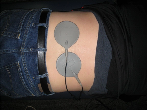 Acupuncture Lake Villa IL Electrical Stimulation